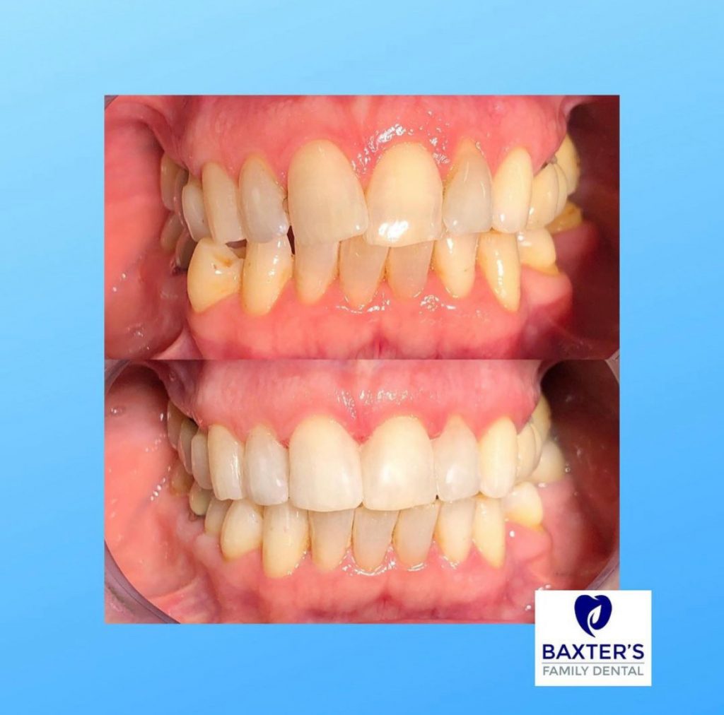 Invisalign Newmarket | Invisible Braces Bury St Edmunds