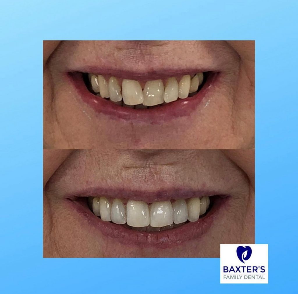 Invisalign Newmarket | Invisible Braces Bury St Edmunds