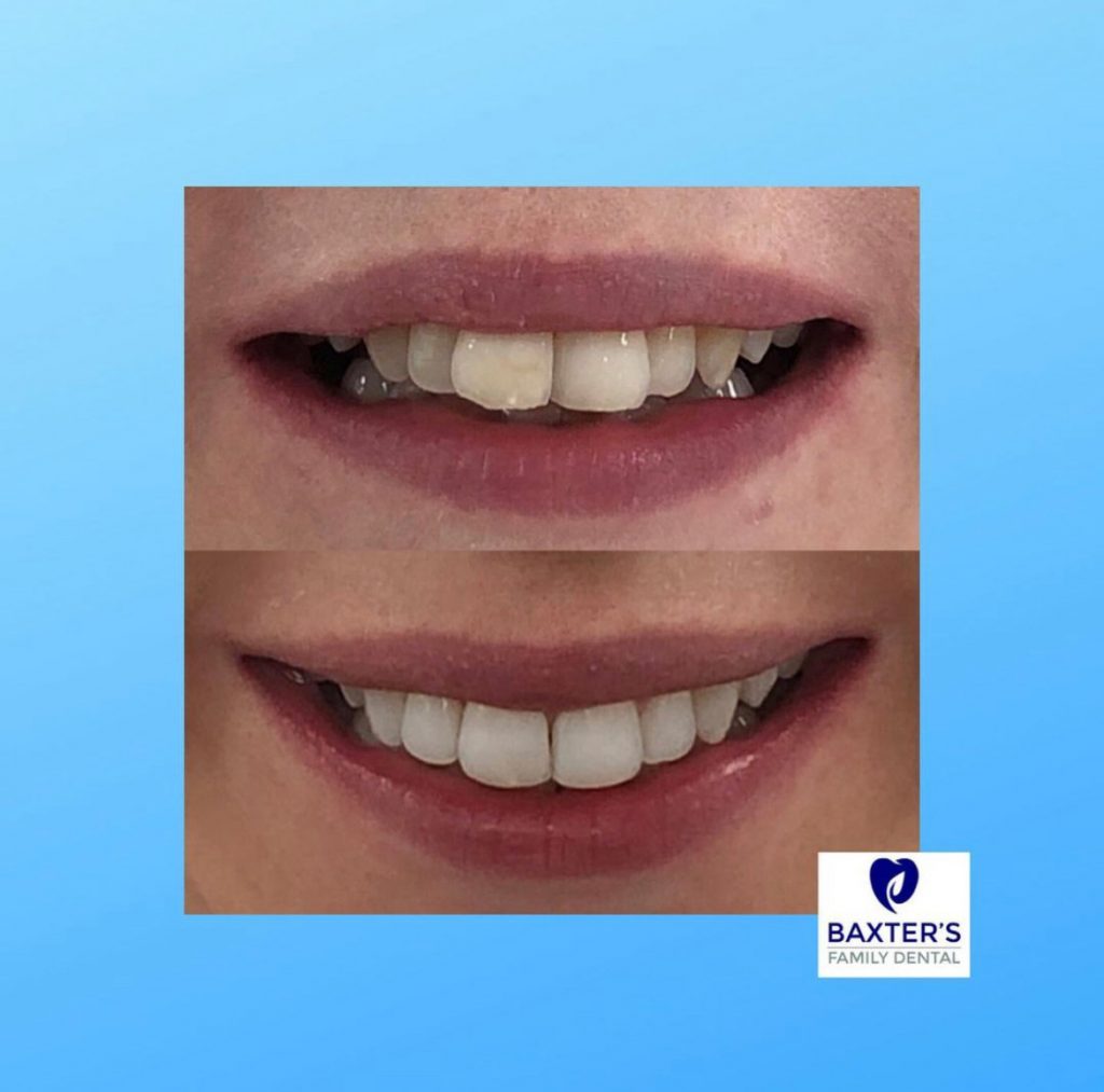 Invisalign Newmarket | Invisible Braces Bury St Edmunds