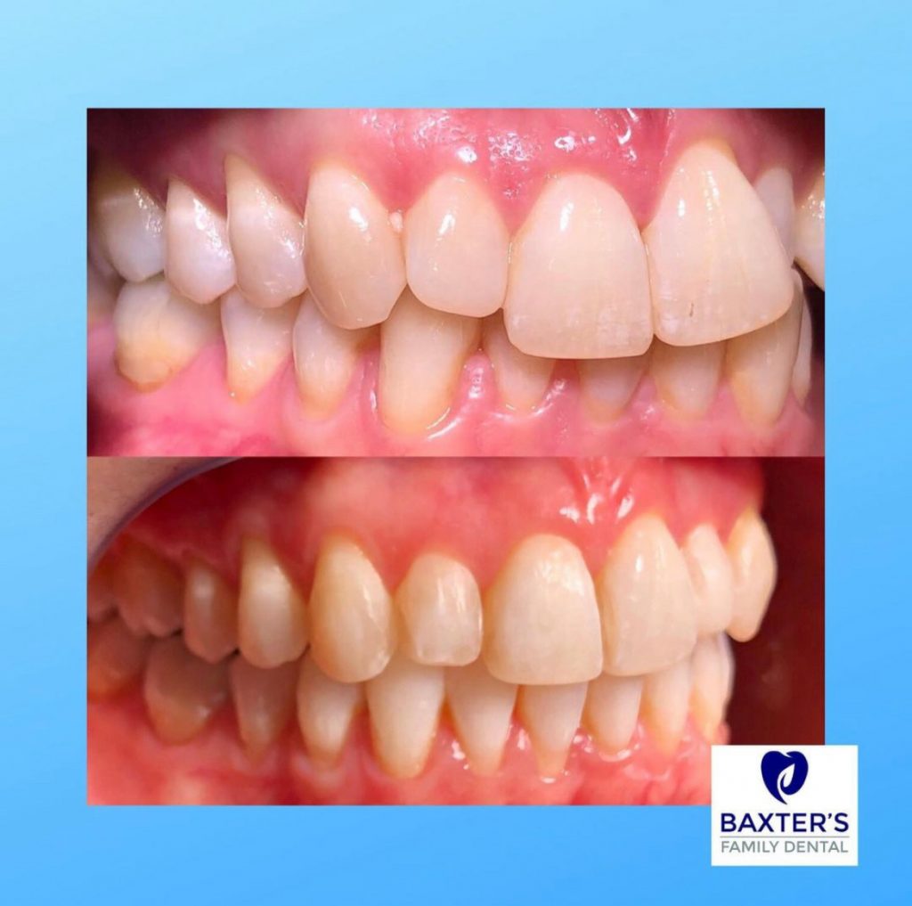 Invisalign Newmarket | Invisible Braces Bury St Edmunds