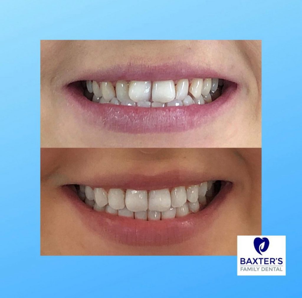 Invisalign Newmarket | Invisible Braces Bury St Edmunds