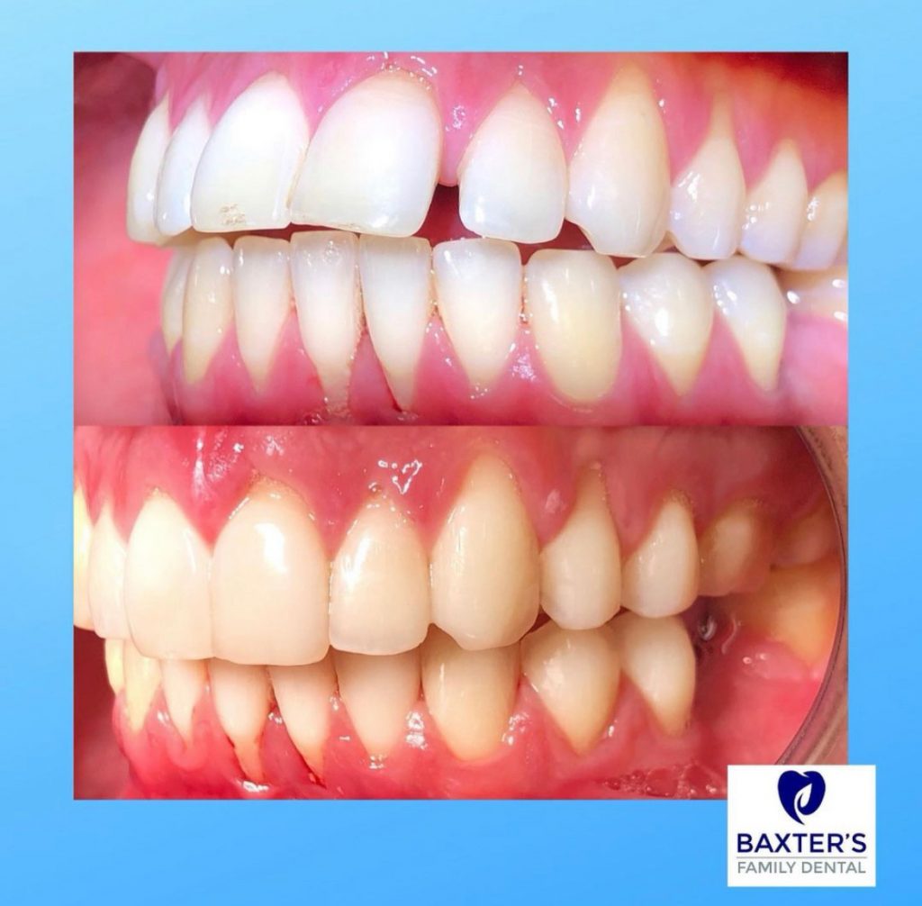 Invisalign Newmarket | Invisible Braces Bury St Edmunds