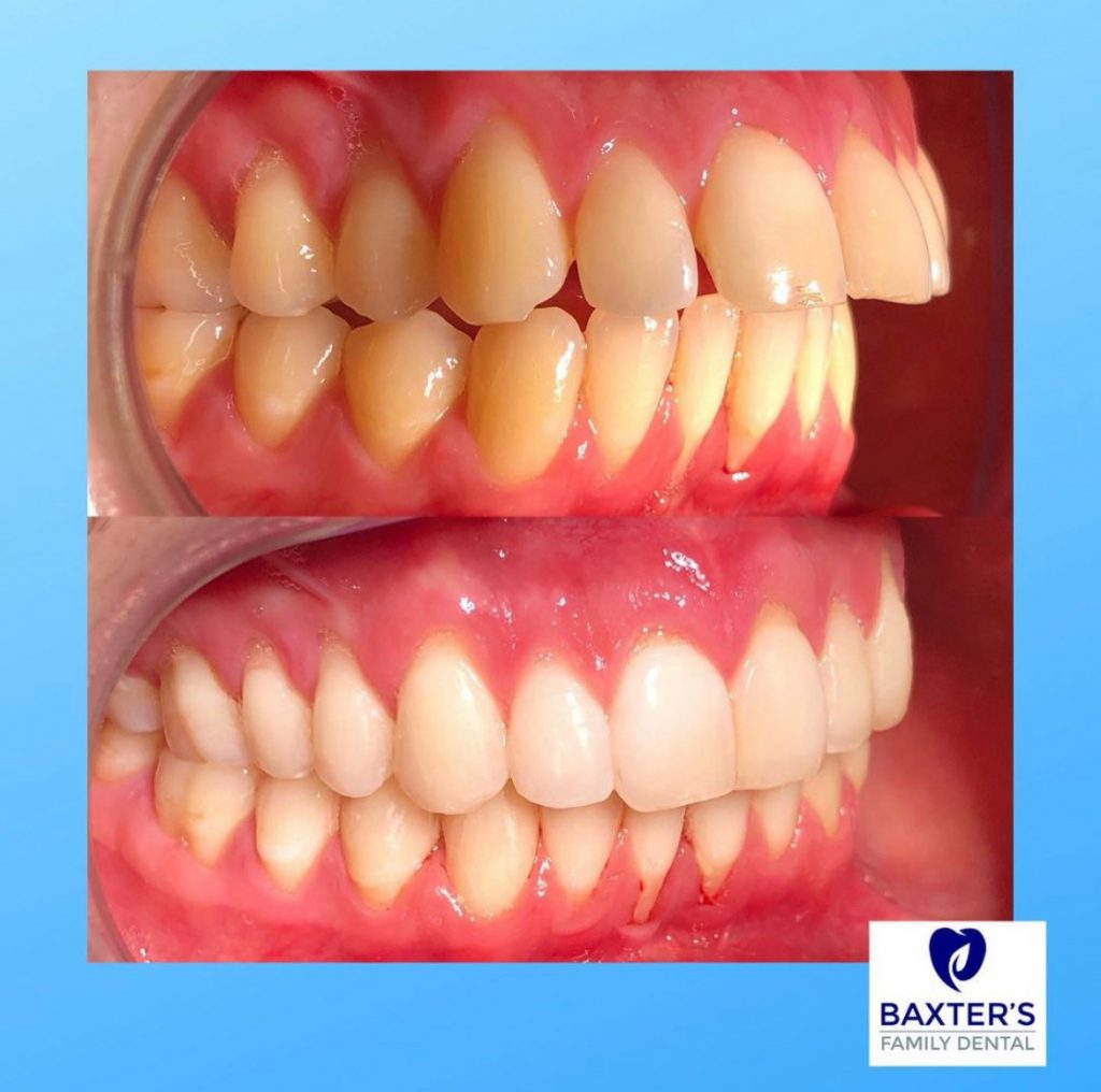 Invisalign Newmarket | Invisible Braces Bury St Edmunds