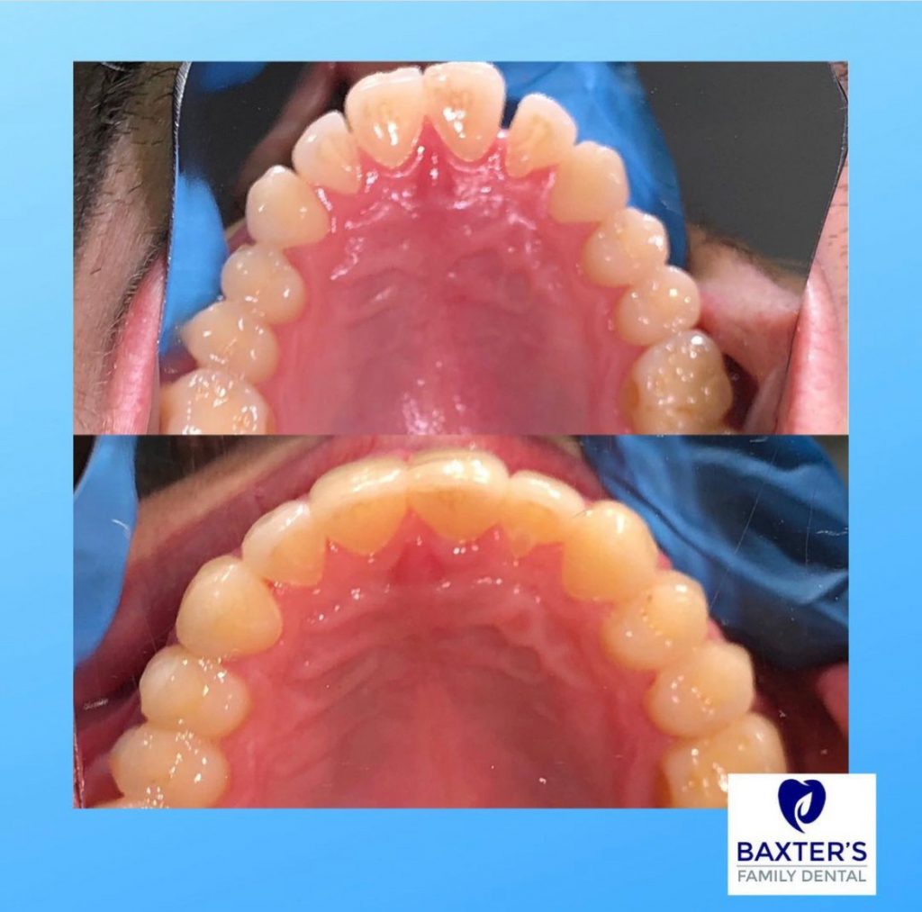 Invisalign Newmarket | Invisible Braces Bury St Edmunds