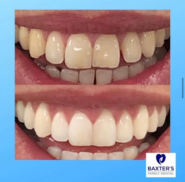 Invisalign Newmarket | Invisible Braces Bury St Edmunds
